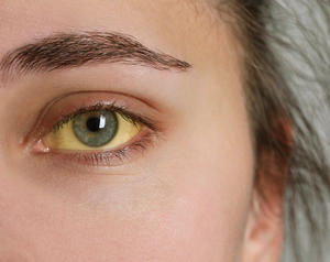Woman with yellow eye – liver disease.