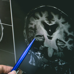 Doctor pointing at brain's gray matter on an x-ray shot